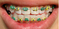 ortodontska terapija