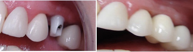 Zubni Implant
