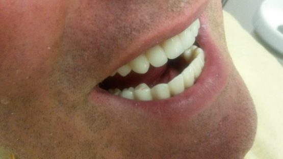 Bezmetalne krunice krune navlake -Cirkon-Stomatolog Beograd-Dr Branislava Smiljković