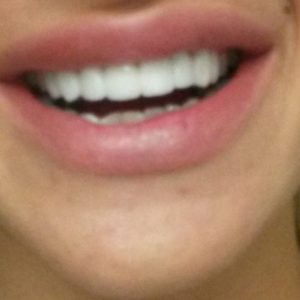 Bezmetalne krunice krune-Gore-White bleaching-Stomatolog Beograd-Dr Branislava Smiljkovic Bezmetalne krunice krune navlake-White bleaching-Stomatolog Beograd-Dr Branislava Smiljković