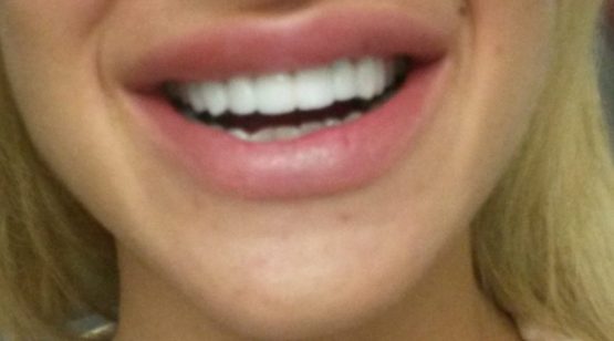 Bezmetalne krunice krune navlake-White bleaching-Stomatolog Beograd-Dr Branislava Smiljković