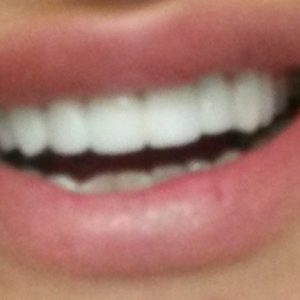 Bezmetalne Krunice-Gore-White bleaching-Stomatolog Beograd-Dr Branislava Smiljkovic Bezmetalne Krunice Navlake-White bleaching-Stomatolog Beograd-Dr Branislava Smiljković