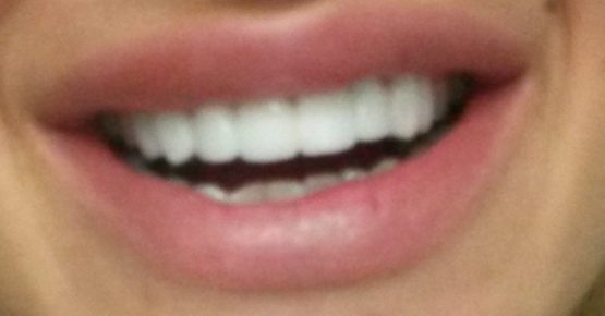 Bezmetalne Krunice Navlake-White bleaching-Stomatolog Beograd-Dr Branislava Smiljković