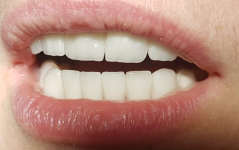 Bezmetalne krunice krune navlake - Zirkon - Gore i dole -Stomatolog Beograd Dr Branislava Smiljković