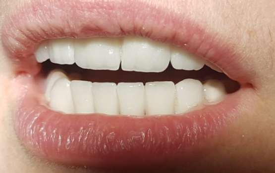 Bezmetalne krunice krune navlake - Zirkon - Gore i dole -Stomatolog Beograd Dr Branislava Smiljković