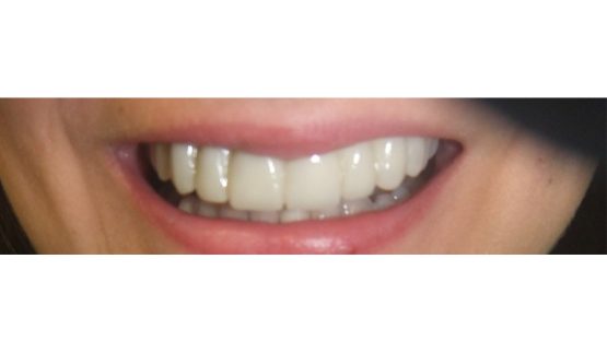 Bezmetalne krunice krune navlake -Stomatolog Beograd