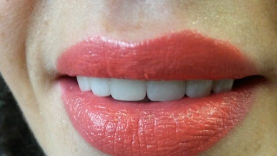 Bezmetalne krunice navlake fasete za zube