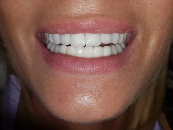 krunice navlake za zube bezmetalne