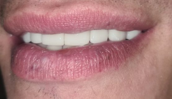 Bezmetalne krunice krune