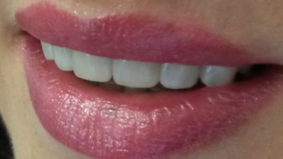 Bezmetalne krunice navlake fasete za zube