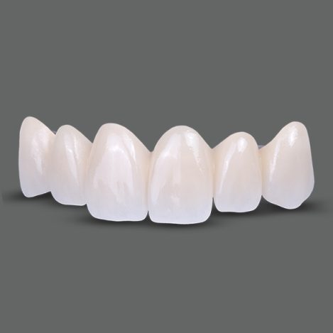 Bezmetalne krunice krune most