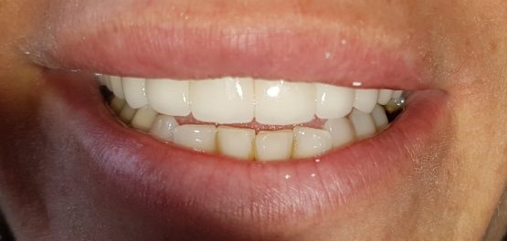 Bezmetalne krunice krune