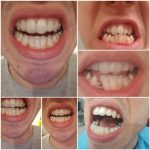 Folije za ispravljanje zuba Invisalign Pre Posle Dr Branislava Smiljkovic