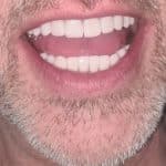 Fasete za zube Keramicke Viniri nonprep stomatolog beografd